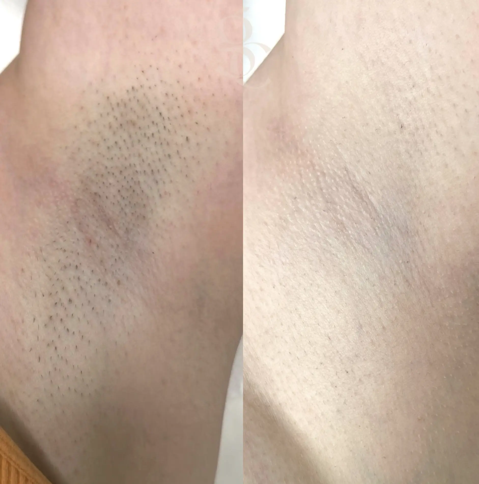 laser hair removal study course