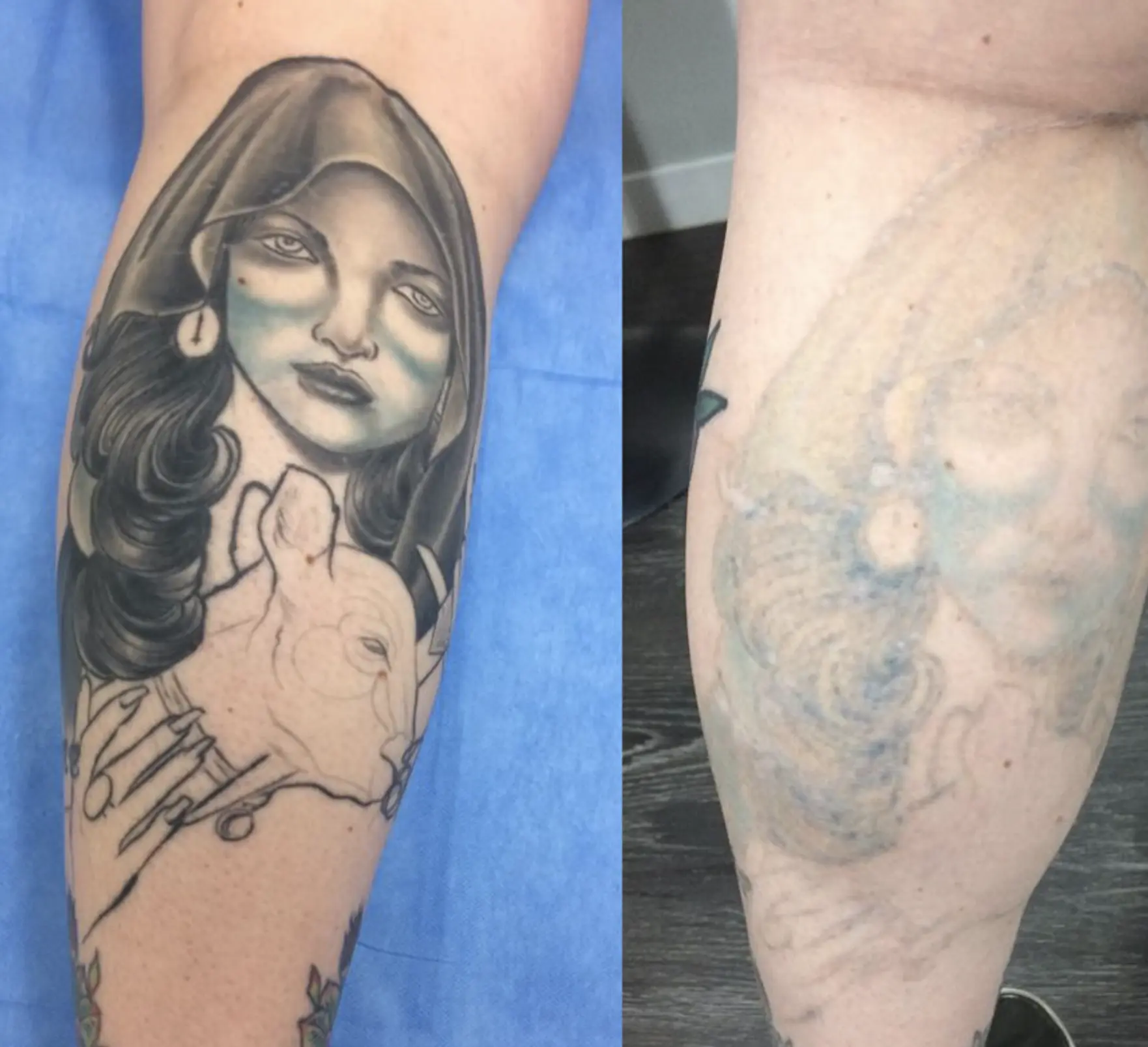 laser tattoo removal training course