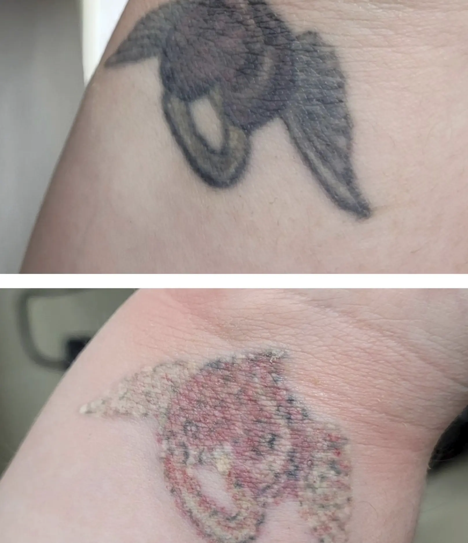tattoo removal course melbourne