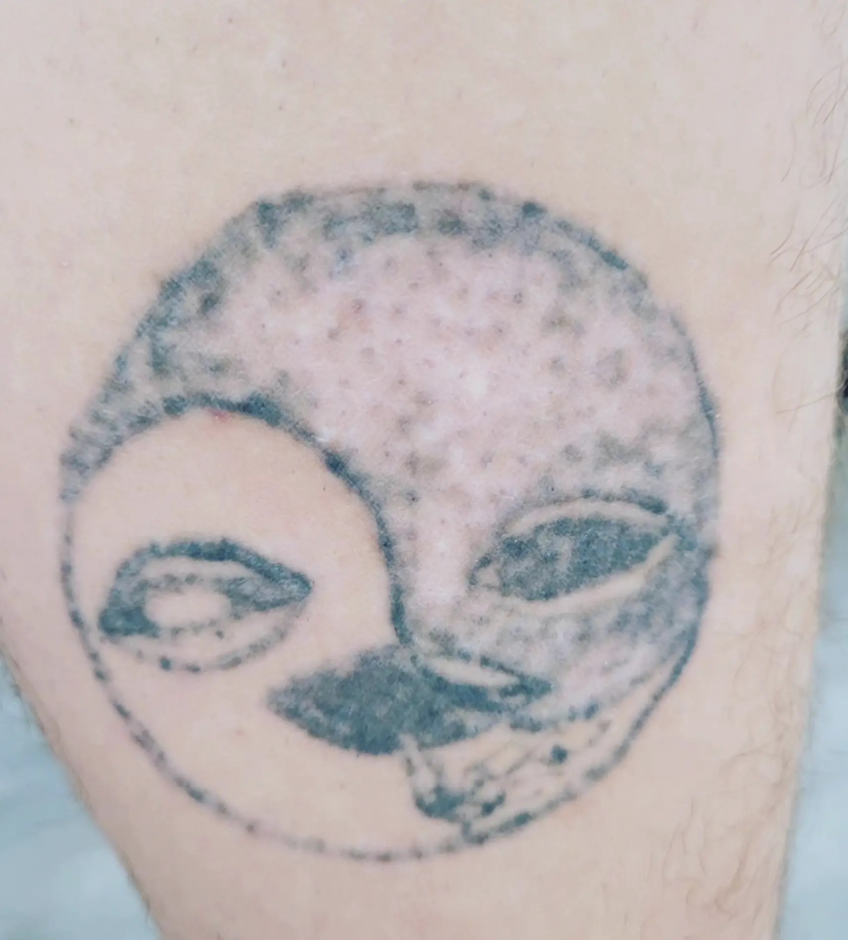 tattoo removal course qld