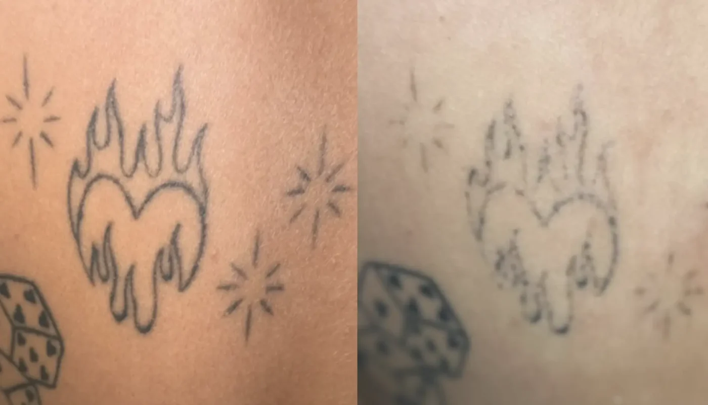 tattoo removal qualifications australia