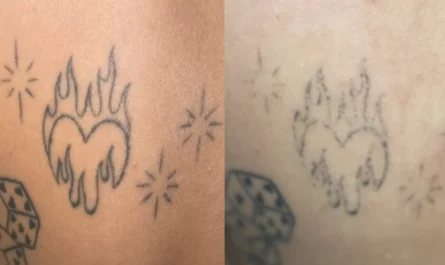 tattoo removal qualifications australia